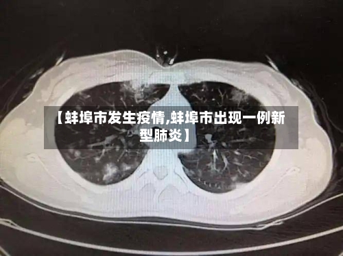 【蚌埠市发生疫情,蚌埠市出现一例新型肺炎】-第1张图片